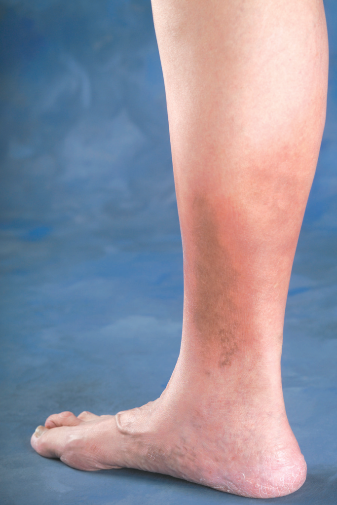 Varicose Veins Five Surprising Symptoms Which Could Indicate The Condition Bluemess 3461